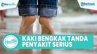 Kaki Terasa Bengkak Dapat Picu Penyakit Serius, Kenali Penyebab Gangguan yang Kerap Disepelekan