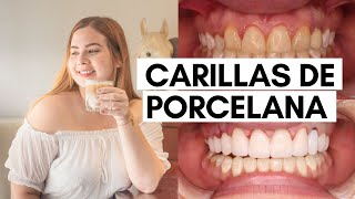 Los que NO te dicen sobre las carillas de porcelana: Dolor, Costo, Vale la pena #carillasdentales