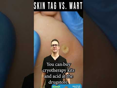Skin Tag Removal Wart Removal How To Get Rid Of Skin Tags Warts