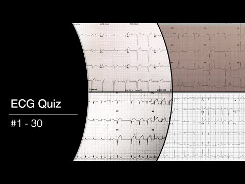 ECG Quiz #1 - 30