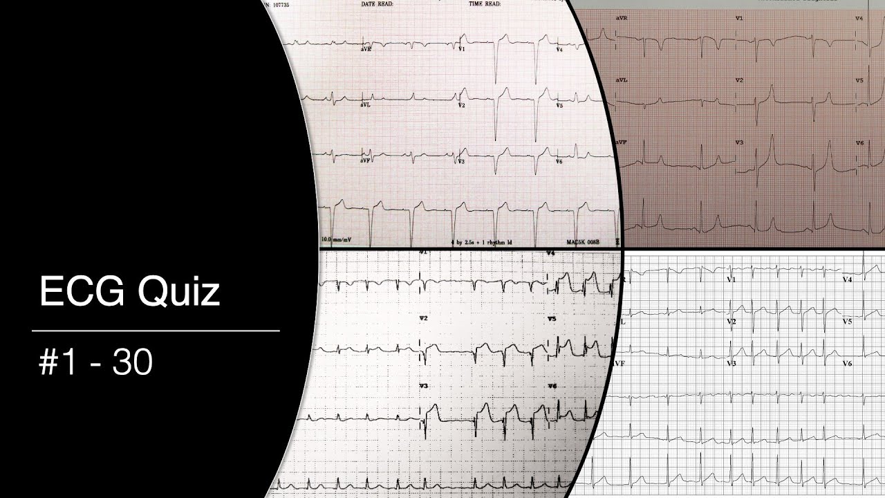 ECG Quiz #1 - 30