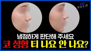 코 성형 티 나기 vs 코 성형 티 안 나기