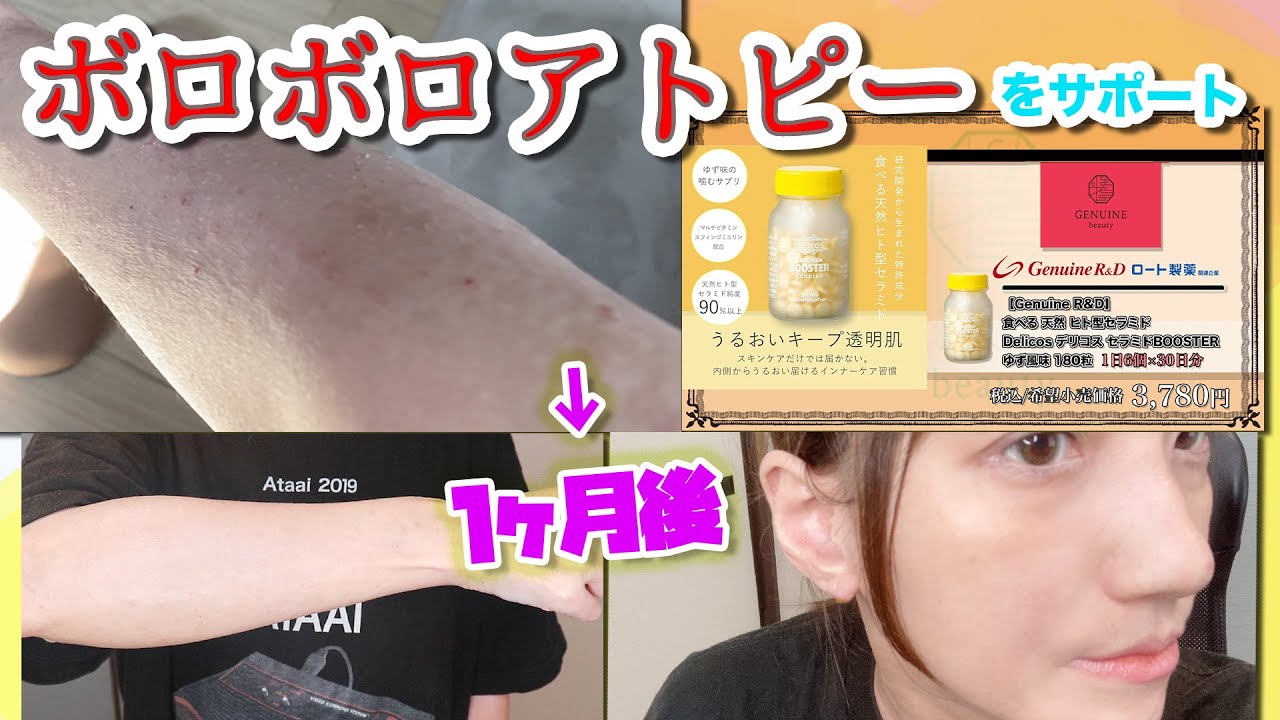 【サプリ】アトピーが悪化⚫︎開き直ってサプリを飲んで経過を記録してみた！