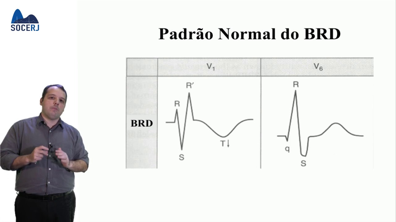 Curso Básico de ECG - Aula 10:  Taquicardias de QRS Alargado