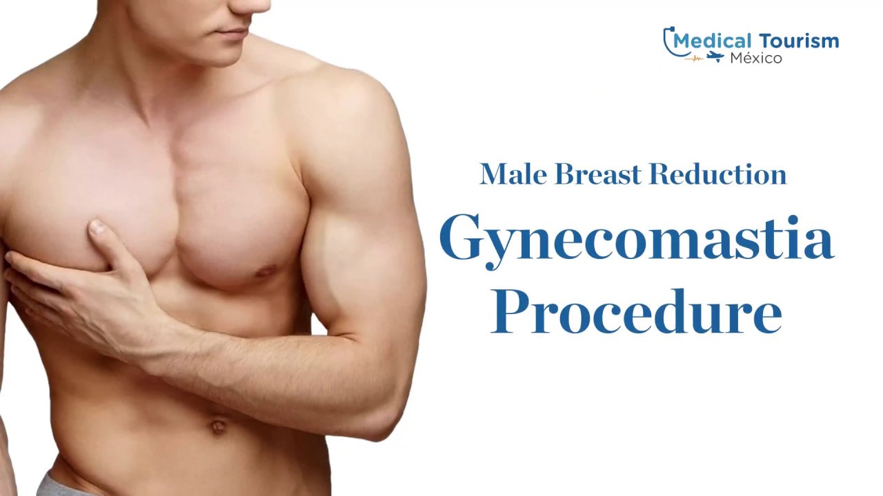 Gynecomastia general information - Medical Tourism Mexico