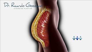 PROTESE DE GLUTEOS - Procurando um bumbum firme e durinho? Conheça esse procedimento estético.