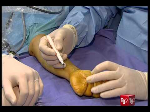 Condizione della persona in osteocondrosi della colonna cervicale Ernia della gobba della colonna vertebrale cervicale
