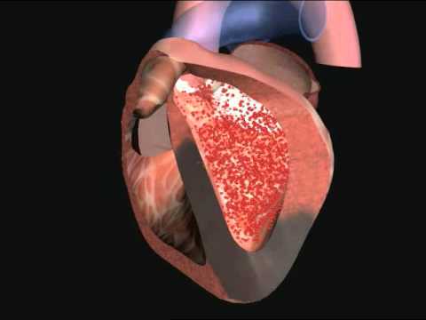 Image of Medical Law Case: Implantable Cardiac Defibrillator