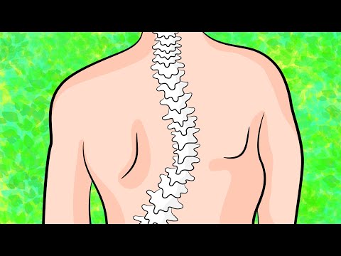 How to get rid of upper back scoliosis in 4 minutes a day