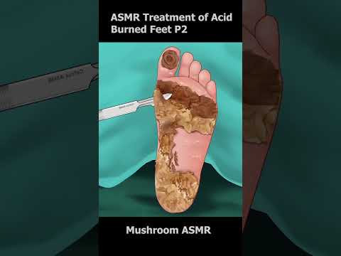 ASMR Treatment of Acid Burned Feet so Satisfying #trending #trendingshorts #viral #satisfying #asmr