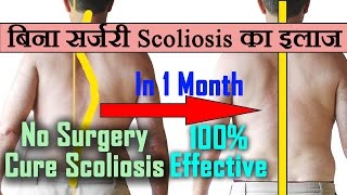 Scoliosis-100% Effective Scoliosis Treatment Exercises At Homeस्कोलियोसिस का बिना सर्जरी इलाज