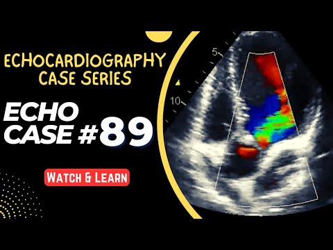 ECHO CASE 89 | Echocardiography Case Series | Echocardiogram Interpretation | 2D Echo Basics