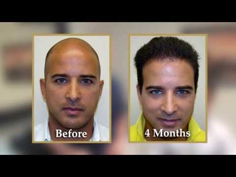 Aldo's Undetectable Scar: 8mo