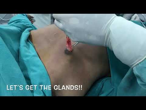 Patient Recovery Case — Video 36 (Body Sculpting)