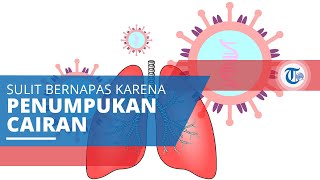 Edema Paru, Gejala Sulit Bernapas akibat Terjadinya Penumpukan Cairan di dalam Kantong Paru-paru