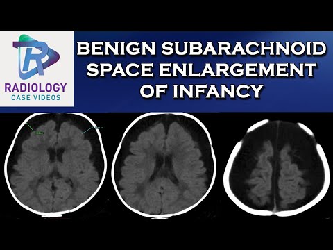 Benign Subarachnoid Space enlargement of infancy