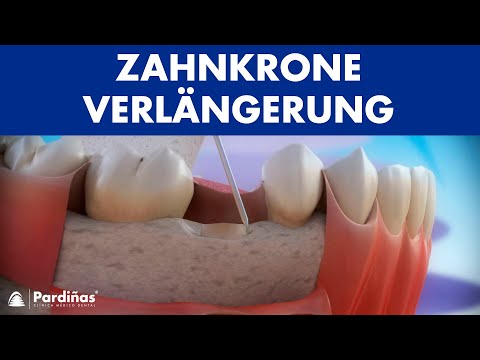 Zahnkrone Verlängerung ©