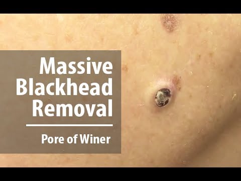 Removing Massive Blackhead | Pore of Winer