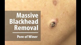 Removing Massive Blackhead | Pore of Winer