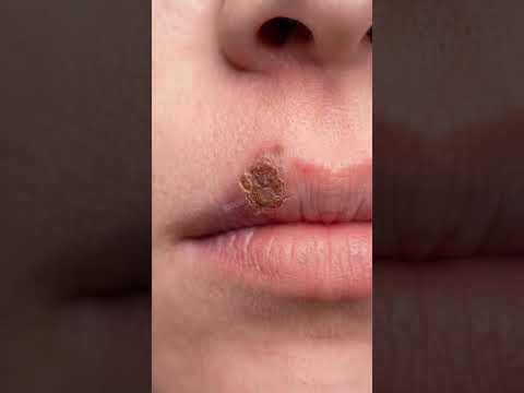 🛟 STD Herpes (Cold Sores): Early Signs, Prevention & Safe Sex Tips | Dr. Rahman #Shorts