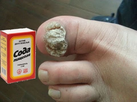 Die Nägel vom Salmiakgeist zu behandeln Die Gräser gribok auf dem Nagel