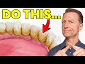 The 1 Top Remedy For Dental Plaque TARTAR