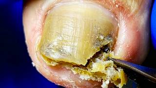 Toenail Fungus Spreads, Get A Silky Smooth Trim~【Xue Yidao】
