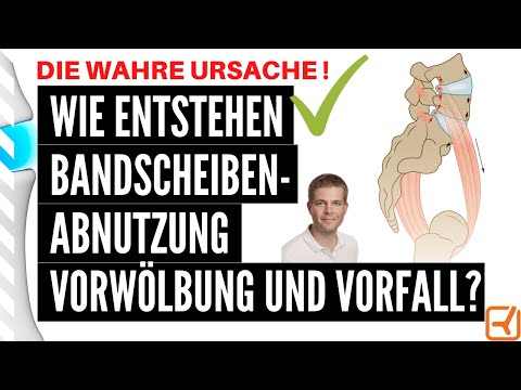 Wie entstehen Bandscheibenabnutzung, -vorwölbung und Bandscheibenvorfall? Die wahre Ursache!