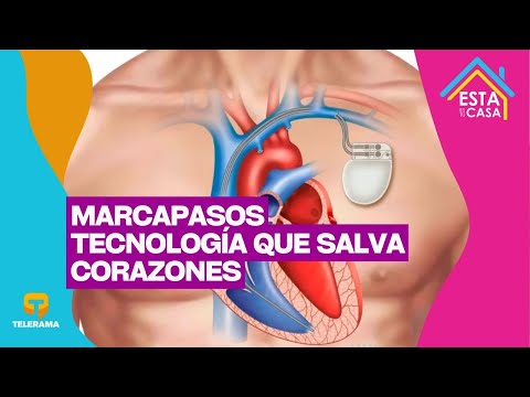 Marcapasos: Tecnología que salva corazones
