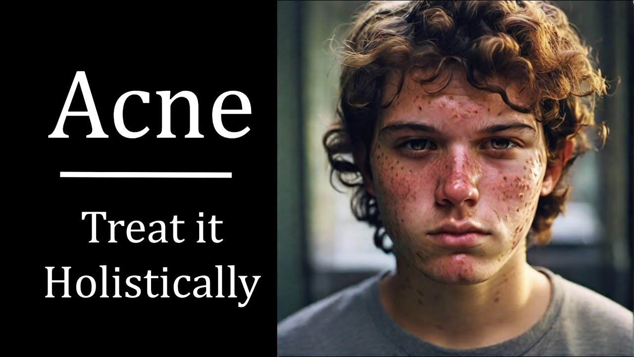 Treat Acne Holistically