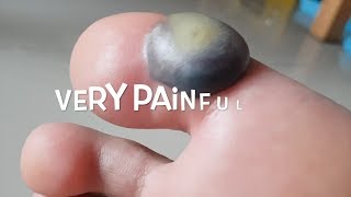 Big blood blister after liquid nitrogen cryotherapy