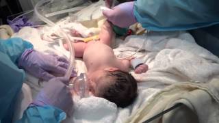 Twin Babies C-Section Birth - 36 weeks