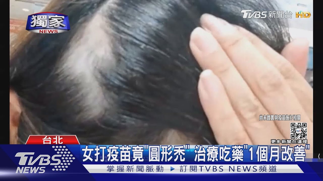 打完莫德納近3個月 狂掉髮「快禿」醫:恐難長