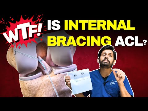 The SHOCKING Truth About Internal Bracing ACL Surgery