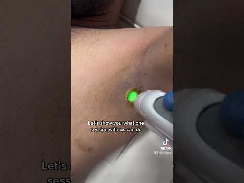 Eight weeks after one laser hair removal session