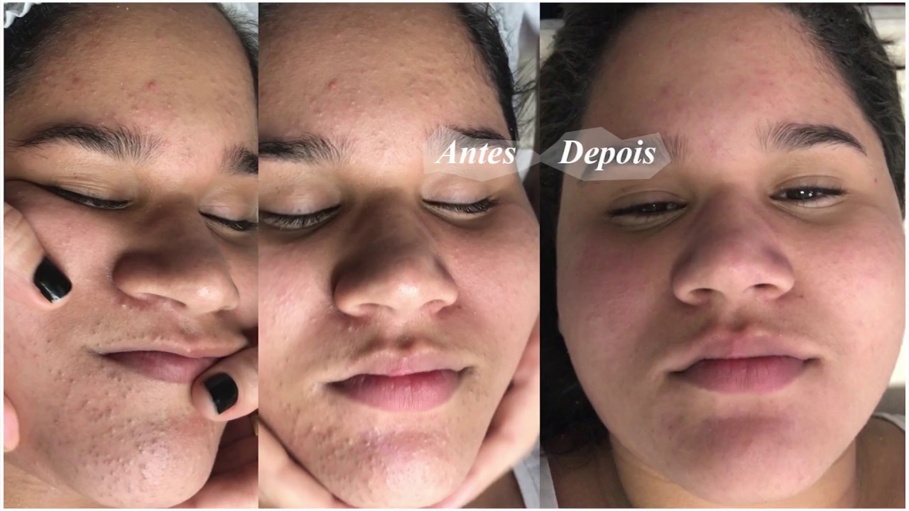 Pele com Muita Acne - Limpeza de Pele Profunda - Clínica / Centro estética