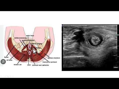 Endometriose em cicatriz de episiotomia. Achados ultrassonográficos.