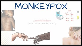 MONKEYPOX- Causes, routes of transmission, diagnosis, prevention & treatment