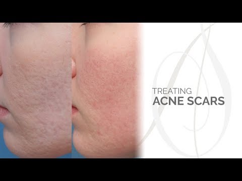 Acne Scars Treatment  Chicago, IL Acne Scars Treatment  Chicago, IL