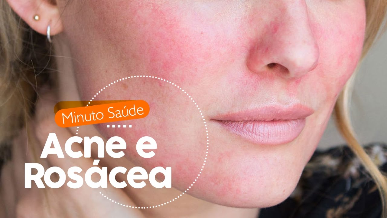 Acne e Rosácea