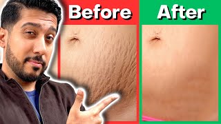 How to Get Rid of Stretch Marks | 3 Best Stretch Mark Treatments