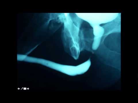 Pelvic Fracture Complications