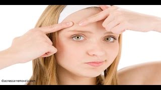 Chemical Peels Treatment for Acne