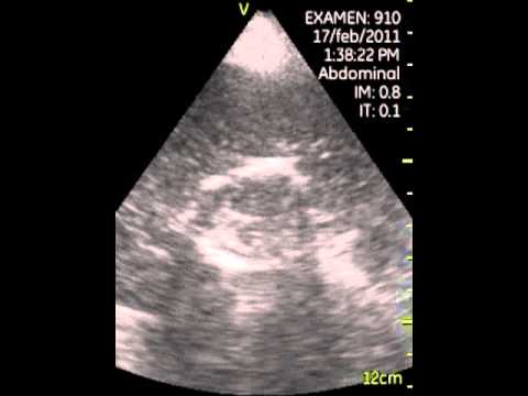 Hydatid Cyst