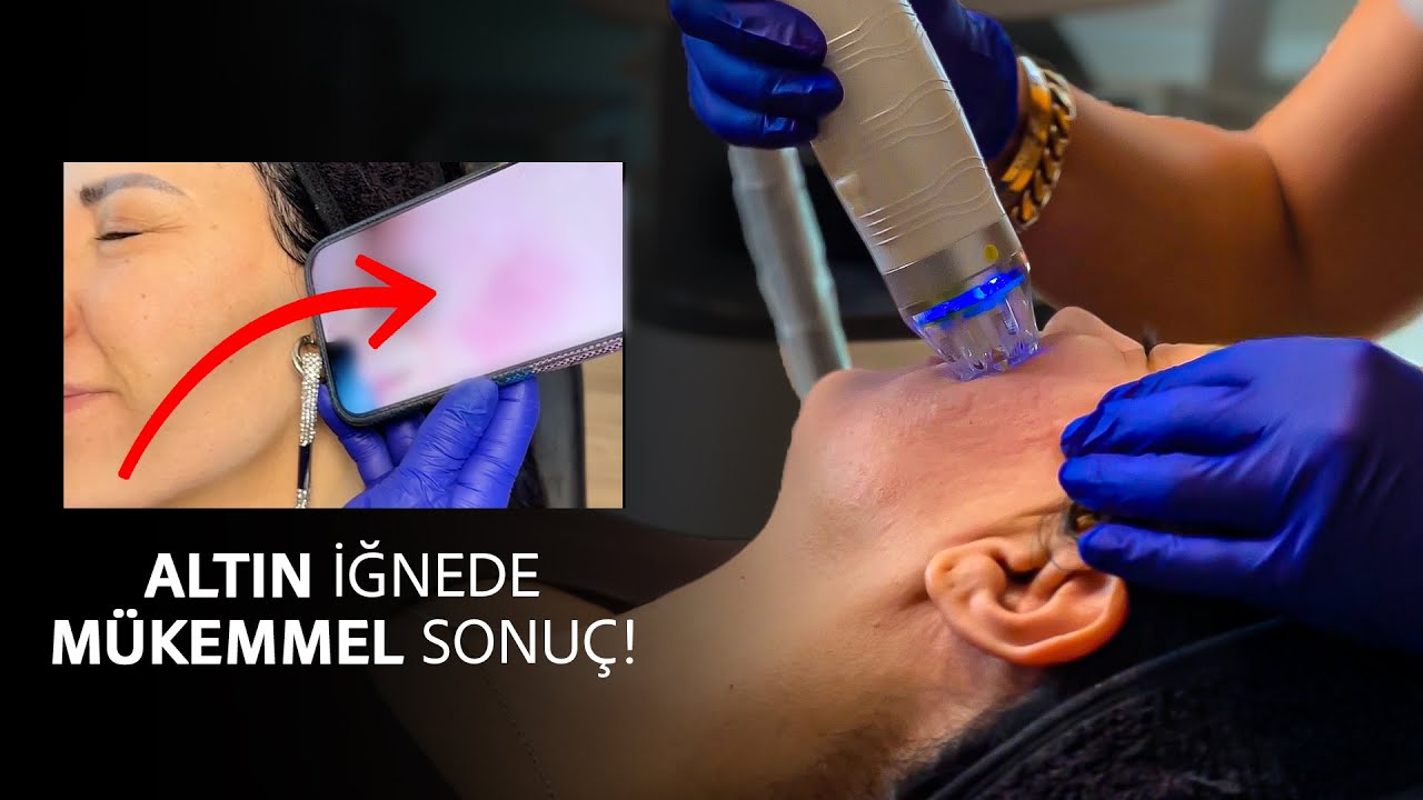 IŞILDAYAN CİLT DÖNÜŞÜMÜ I PEELİNG, PRP VE ALTIN İĞNE (RF MİKROİĞNELEME) İLE İLERİ CİLT YENİLEME
