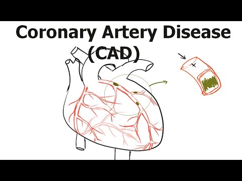 Coronary Artery Disease/ causes of CADs/ Classification of CADs