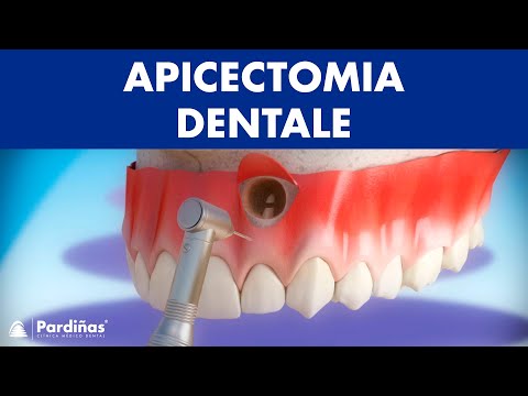 Apicectomia dentale ©