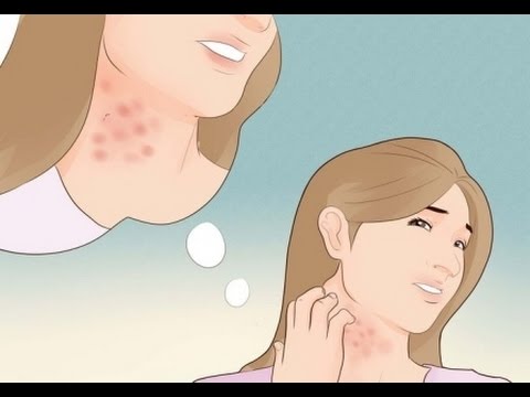 La eccema córnea sobre las palmas La psoriasis que se moja de la cabeza