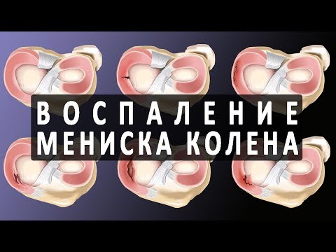 Прогестерон боль в суставах Лечение при остеоартрозе коленного сустава