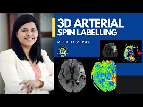 3D ARTERIAL SPIN LABELLING | MITUSHA VERMA | NEW MR TECHNIQUES | ADVANCED STROKE IMAGING | PENUMBRA